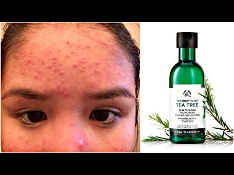 TEA TREE OIL RUINED MY FACE & How I Cleared it Back Up
