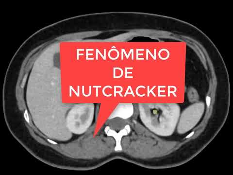 Fenômeno de nutcracker, possível causa de varizes pélvicas e de dor pélvica crônica mas mulheres.