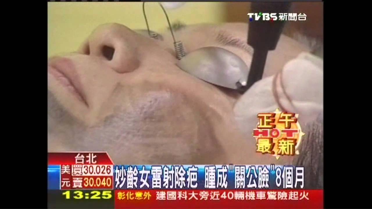 妙齡女雷射除疤 腫成「關公臉」8個月