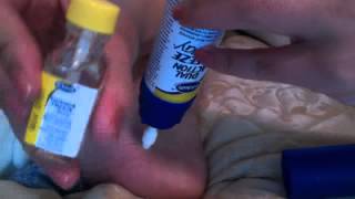 Dr. Scholl's Dual Action Freeze Away Wart remover HOW TO step by step