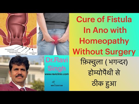 Cure of Fistula in Ano with Homeopathy