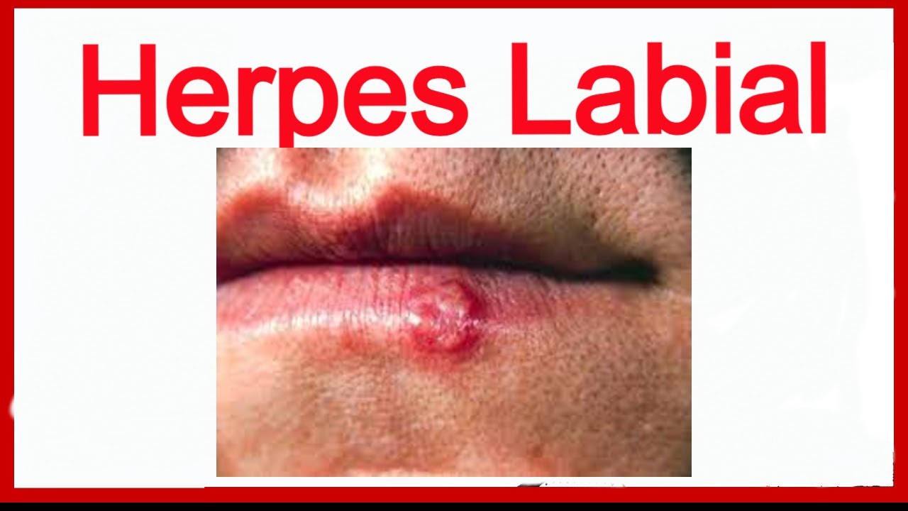 HERPES LABIAL Emociones y conflictos
