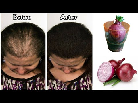 , title : 'How to use onions for hair growth makes hair grow non-stop / the best Indian secret for hair growth'