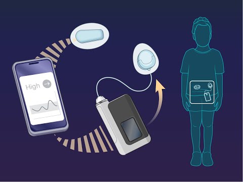 Closed-Loop Therapy in Very Young Children with Type 1 Diabetes | NEJM