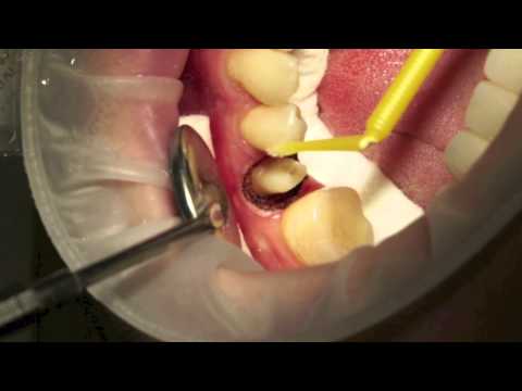 Tooth restoration - Harvard ZirconCore Cement/Fiber Glass Post/Diode Laser