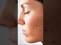 Warning How To Safely Remove Moles From Your Face Shorts Til Facemoles