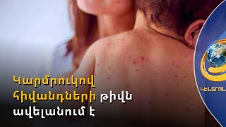 Կարմրուկի դեմ պայքարի միակ միջոցը