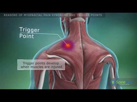 Myofascial pain syndrome and trigger points. Reasons