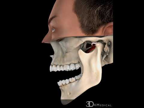 TMJ, without Reduction