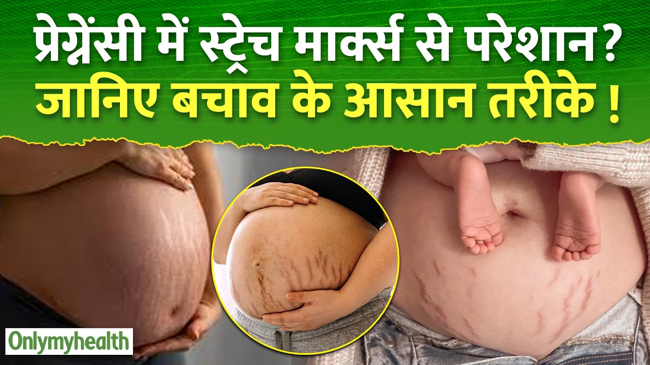 प्रेग्नेंसी में स्ट्रेच मार्क्स से परेशान : जानिए बचाव के आसान तरीके I Only My Health