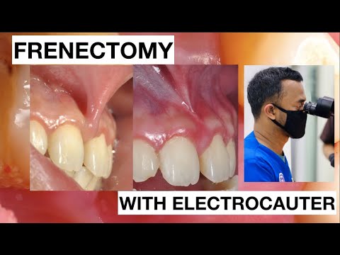 Frenectomy with Electrocauter cause teeth Gaps