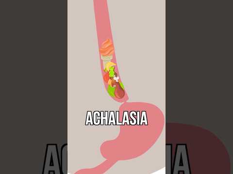 When Your Esophagus Doesn't Work 🥴