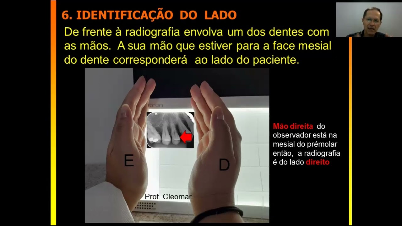 Identificação do Lado em Radiografias Periapicais e Montagem em Cartelas