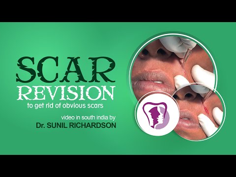Scar Revision To Get Rid Of Obvious Scars