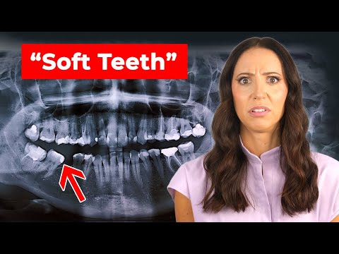 Everyone Thinks They Have This… (Soft Teeth)