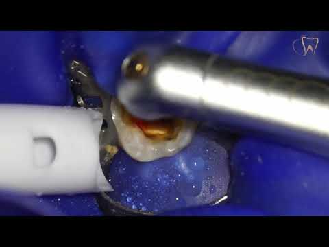 Pain free dental fillings