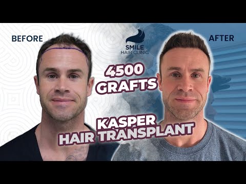 12 MONTHS HAIR TRANSPLANT RESULTS OF OUR PATIENT FROM...