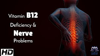 Vitamin B12 Deficiency & Nerve Problems : What You Must Know
