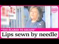 Woman Arrested After Allegedly Sewing Housemate S Lips Shut