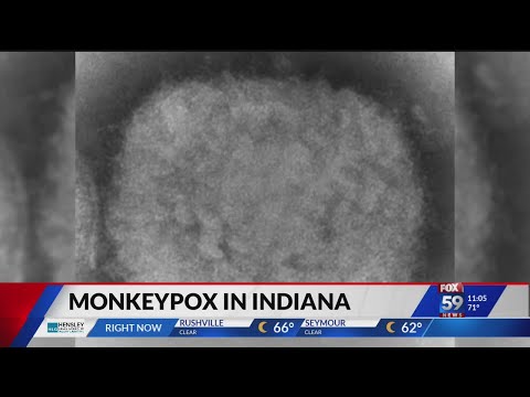 Indiana health officials identify first probable case of monkeypox in state