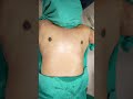 Gynecomastia Surgery Shortvideo Dezireclinicindia