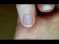 The Basics: How to Remove a Splinter | WebMD