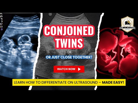 Conjoined Twins or Just Close Together? | Easy Ultrasound Differentiation
