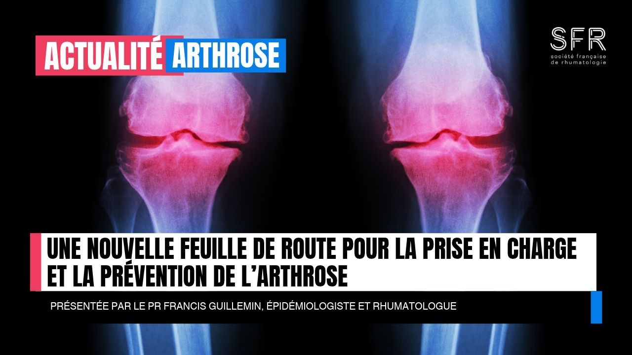 Une nouvelle feuille de route pour la prise en charge et la prévention de l’arthrose