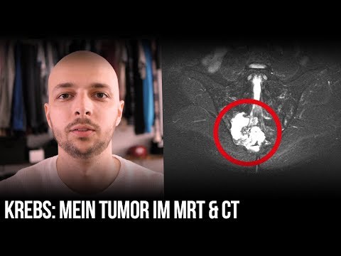 Übungen für die Beweglichkeit der Gelenke in der Schulter Hernie im Nacken Behandlung