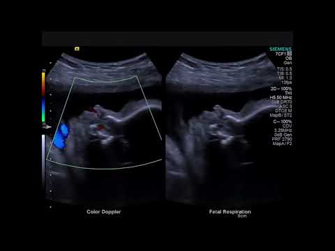 Siemens ACUSON S1000