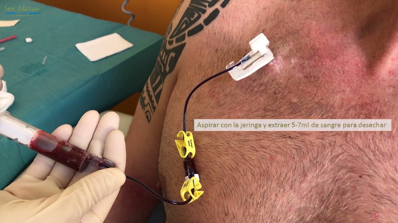 Técnica de punción y cuidados del reservorio subcutaneo (port-a-cath)