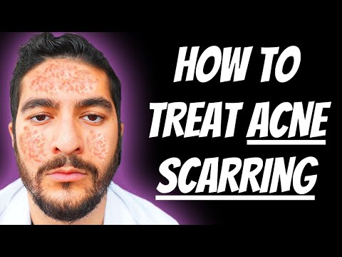 How To Treat Acne Scarring (2025)