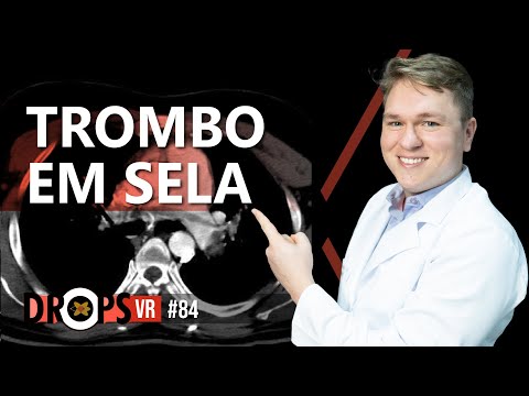 TROMBO EM SELA RECONHECENDO TEP MACIÇO