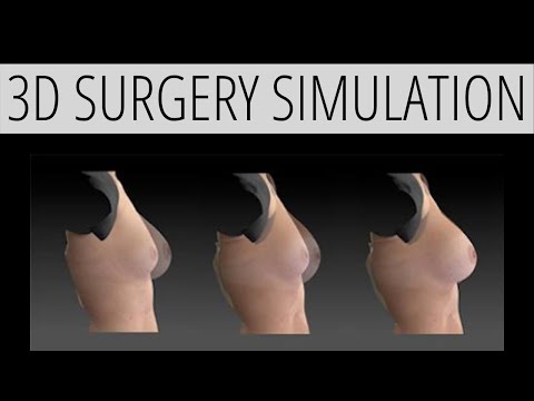 VECTRA 3D Plastic Surgery Simulation | Dr. John Diaz | Beverly Hills