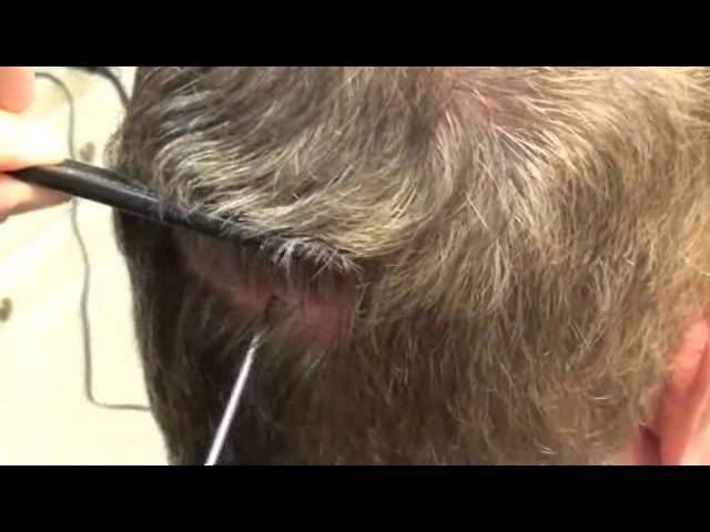 Stewart's Scar