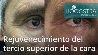 Rejuvenecimiento del tercio superior de la cara (21030)