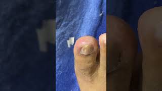 Ep_8840 Foot nails skin removal 👣 ผมเจ็บจนเป็นไข้มา 2 อาทิตย์ครับ 😅 (clip from Thailand)