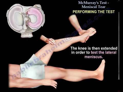 McMurray's Test - Everything You Need To Know - Dr. Nabil Ebraheim