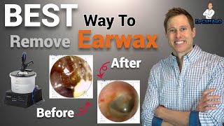 The BEST Way to Professionally Remove Earwax | Earigator Cerumen Irrigation