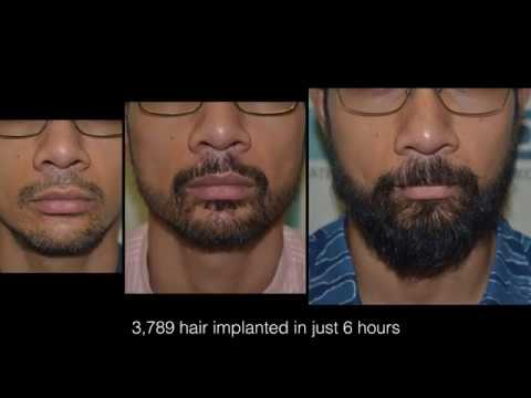 Best Beard Transplant Clinic - DHI Direct Technique - Amazing Beard Transplant Results