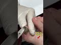 Pt 1 Grinding Down Long Thick Toenails Oddly Satisfying Foot Transformation Shorts Satisfying