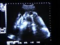 1992 06 Hope Before After Birth