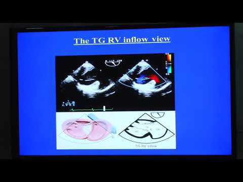 20180820_4_ Assessment of Right ventricle_ Rupa Sreedhar_Dr