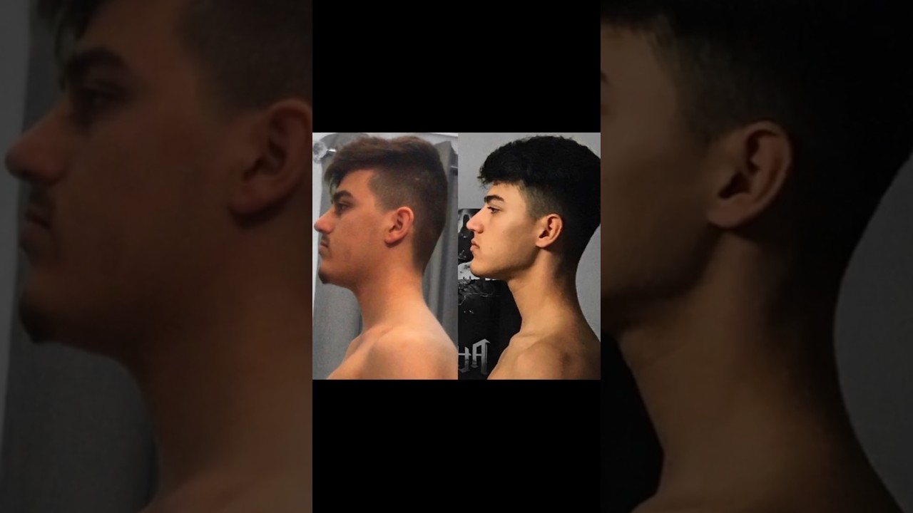 Crazy mewing progress #shorts #mewing #mewingprogress #mewingtransformation