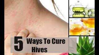 5 Ways To Get Rid Of Hives | By Top 5.