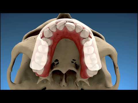 RehaSplint Temporary Dental Splint Product Video