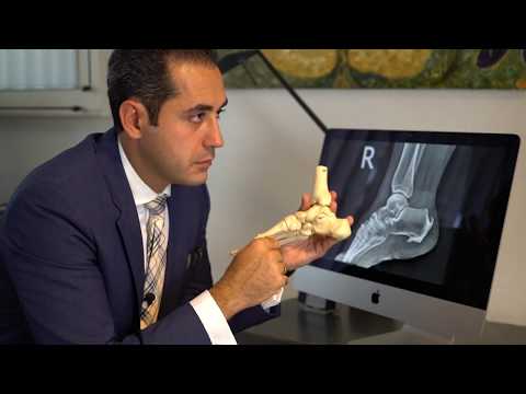 Fersensporn-Behandlung mit fokussierter Stoßwellentherapie | Dr. Ghasemi | Orthopäde Düsseldorf