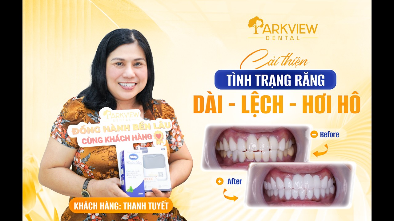 “Công Nhận Bác Sĩ Giỏi Thiệt” – Khách Chia Sẻ Sau Khi Sửa Implant Tại Parkview