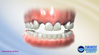 Missing Lateral Implant Replacement