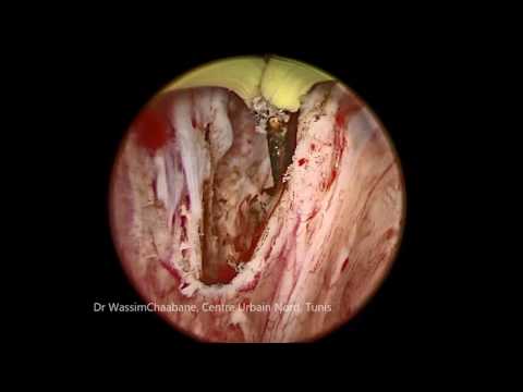 Prostate enucleation (antegrade ejaculation preserved)